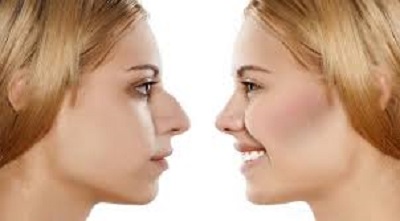 prix d'une rhinoplastie en tunisie