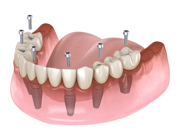 Implant dentaire All On 6 Turquie