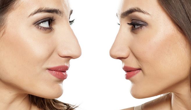 Chirurgie esthétique rhinoplastie secondaire Tunisie tout compris